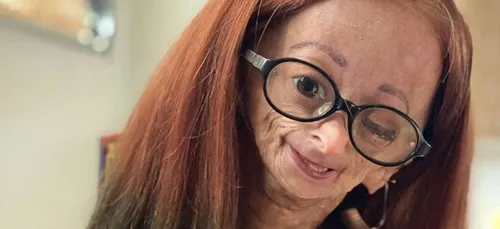 Adalia Rose Williams, jeune Youtubeuse de 15 ans, est décédée