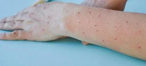 Premier cas de variole du singe chez un enfant dans une école primaire